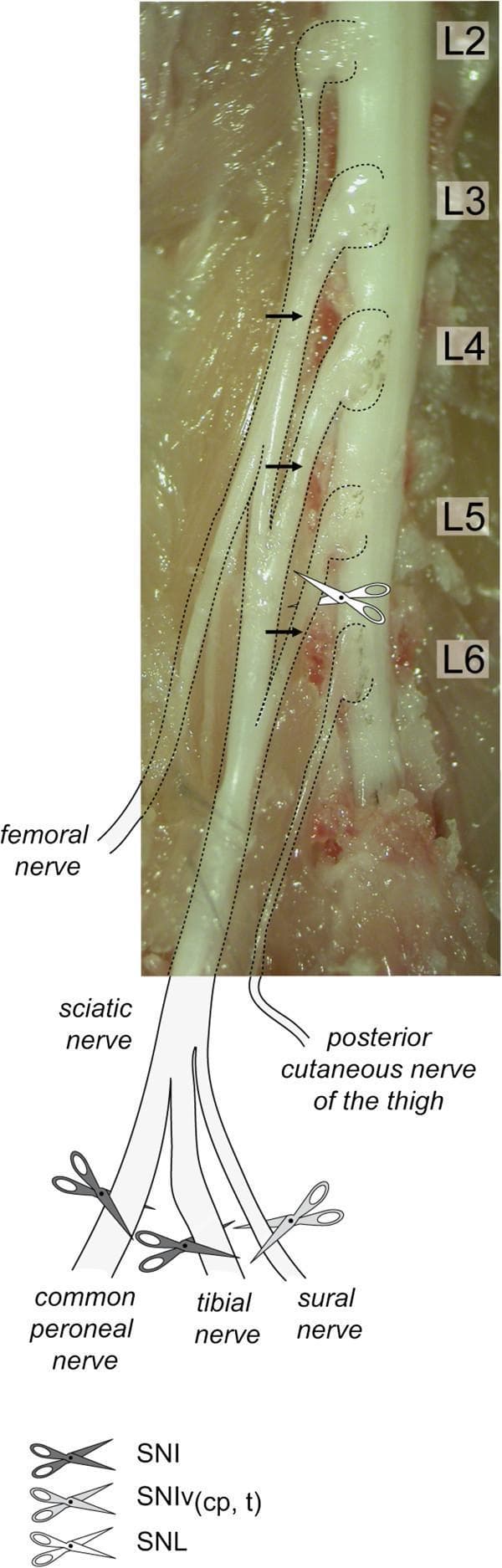 A clinical photograph and schematic anatomical diagram depicting a postero-lateral view of a mouse spinal dissection, specifically focused on the lumbar dorsal root ganglia (DRG) and the formation of the sciatic nerve. The image identifies spinal nerves L2 through L6 and their associated DRGs. Black arrows indicate that the L3, L4, and L5 spinal nerves are the primary contributors to the sciatic nerve, while L6 is shown not contributing. Adjacent to the photograph, a diagram illustrates the sciatic nerve's trifurcation into the common peroneal, tibial, and sural nerves, along with the posterior cutaneous nerve of the thigh. The figure serves as a surgical guide for nerve injury models, using scissor icons to designate specific lesion sites: Spared Nerve Injury (SNI) on the common peroneal and tibial branches, the SNI variant (SNIv) specifically targeting the sural nerve, and Spinal Nerve Ligation (SNL) performed proximally at the L5 spinal nerve level. This anatomical reference is crucial for translational research in neuropathic pain and neurophysiology.