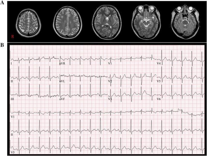 This composite medical visual contains two primary elements: diagnostic neuroimaging and a cardiovascular tracing. The top panel (A) displays a sequence of five axial T2-weighted brain MRI scans ranging from the cranial vault to the base of the skull. These images depict normal neuroanatomy, including the cerebral cortex, subcortical white matter, lateral ventricles, basal ganglia, brainstem, and cerebellum, with no visible intracranial pathology or structural abnormalities. The bottom panel (B) is a standard 12-lead electrocardiogram (ECG) printed on grid paper. The tracing shows a narrow-complex rhythm with a visible P wave preceding each QRS complex, consistent with sinus rhythm. The heart rate is notably elevated, approximately 115 beats per minute, indicating sinus tachycardia. The combination of normal brain imaging and an ECG showing sinus tachycardia is used in a clinical context to evaluate post-traumatic autonomic dysfunction, such as postural orthostatic tachycardia syndrome (POTS) or other dysautonomias following a traumatic brain injury (TBI).