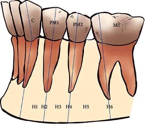 This anatomical diagram provides a schematic representation of the horizontal classification of the mental foramen (MF) position relative to the mandibular teeth, commonly used in maxillofacial radiology and surgical planning. The illustration depicts the left mandibular segment from the canine to the first molar. Six specific horizontal positions (H1–H6) are categorized based on their anterior-posterior relationship to the tooth axes: H1 is located between the canine (C) and first premolar (PM1); H2 aligns with the long axis of the PM1; H3 is positioned between the first and second premolars (PM2); H4 aligns with the long axis of the PM2; H5 is located between the PM2 and the first molar (M1); and H6 aligns with the mesial root of the M1. Blue vertical lines illustrate the long axes of the teeth to define these anatomical landmarks. This diagram serves as an educational tool for dental students and clinicians to understand the common anatomical variations of the mental nerve exit point, which is critical for local anesthesia and avoiding neurovascular injury during dental implantation or mandibular surgery.