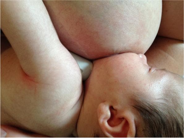 Clinical photograph of a 4-week-old infant breastfeeding using the 'gestalt' method, emphasizing optimal latching mechanics and positional stability. The image shows the infant in a cross-cradle or similar hold, with the head tilted slightly upward (asymmetric latch). The infant's mouth is wide open and deeply attached to the breast, though the nipple itself is not visible. Notably, the infant's nose is in close contact with the breast tissue, and the chin is tucked firmly into the breast. A white nipple shield is partially visible at the point of attachment. The infant's skin is fair with fine vellus hair, and the scalp has dark hair. The maternal breast appears full and rounded, with visible skin texture and faint vascular patterns. This image demonstrates post-intervention positioning intended to address nipple pain and infant fussiness associated with latch difficulties or oral connective tissue restrictions.