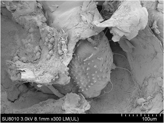 Scanning electron microscopy (SEM) image at 300x magnification illustrating an adult female Sarcoptes scabiei mite within a cutaneous burrow, a hallmark finding of human scabies. The mite features a characteristic oval, dorsoventrally flattened body with a highly textured integument. Visible morphological details include transverse ridges (striations) on the anterior dorsal surface and numerous short, conical spines (protuberances) and long, hair-like setae extending from the posterior and lateral margins. The mite is partially embedded in an irregular tunnel composed of fragmented keratinocytes and skin debris. Adjacent to the mite within the burrow are several small, ovoid, hardened masses representing scybala (fecal pellets). This image serves as a high-resolution diagnostic demonstration of the pathophysiology of crusted scabies, highlighting the mite's burrowing behavior and the accumulation of metabolic waste within the stratum corneum.
