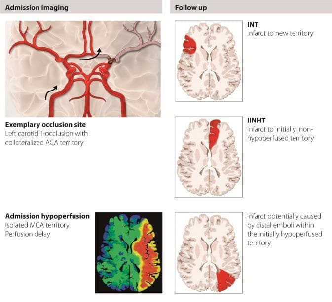 A medical infographic and diagrammatic summary illustrating the pathophysiology and classification of stroke infarcts following mechanical thrombectomy. The left panel, labeled 'Admission imaging,' displays a stylized anatomical diagram of the Circle of Willis showing a left carotid T-occlusion. Arrows indicate collateral blood flow to the anterior cerebral artery (ACA) territory, and an axial perfusion map below shows isolated middle cerebral artery (MCA) territory perfusion delay. The right panel, 'Follow up,' presents three axial brain schematics classifying new lesions: 1) 'Infarct to new territory' (INT), showing a focal cortical lesion in the contralateral hemisphere; 2) 'Infarct to initially non-hypoperfused territory' (IINHT), showing a lesion in the frontal lobe of the ipsilateral hemisphere; and 3) an infarct within the initially hypoperfused territory, attributed to distal emboli. The educational focus is on distinguishing procedure-related emboli in new territories versus the progression of the primary stroke territory. This resource is intended for neurology and radiology education regarding ischemic stroke complications.