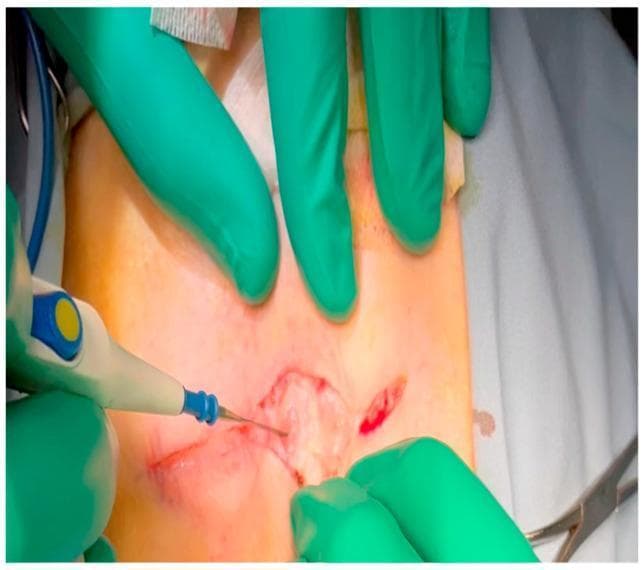 This clinical photograph captures a surgical procedure in progress, specifically the initial stages of a mini-thoracotomy. The image shows a transverse incision being made through the subcutaneous tissue layer using an electrocautery pen (Bovie). The surgical site is located just inferior to the axillary fold. The subcutaneous tissue is visible within the wound, characterized by its pale yellow color and lobulated, fatty texture. Surgeons wearing green sterile gloves are seen retracting the skin and superficial fascia to expose the underlying tissue layers and maintain the surgical field. A pair of surgical scissors is partially visible in the bottom right corner. The electrocautery tip is in contact with the tissue, demonstrating the thermal dissection used to minimize bleeding while progressing through the chest wall layers. This visual is used in medical education to illustrate surgical access, tissue handling, and the use of electrosurgical instruments in cardiothoracic or general surgery.