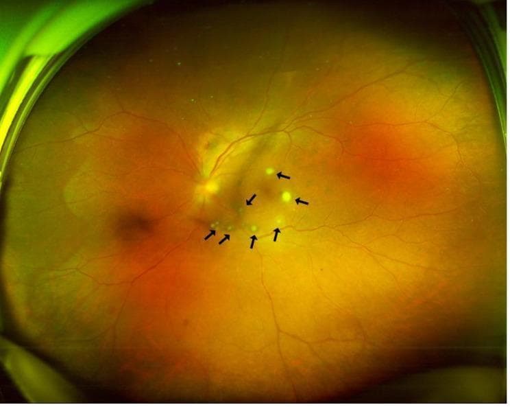This clinical photograph is an ultra-widefield fundus image of a human left eye, illustrating features of endogenous endophthalmitis. The fundus exhibits a generalized orange-yellow hue with a hazy appearance, consistent with significant vitreous inflammation (vitritis). Multiple, small, yellowish-white, circumscribed chorioretinal lesions are scattered across the retina, primarily concentrated in the macular and peripapillary regions. Several of these lesions are specifically highlighted by black arrows, demonstrating their distinct, slightly elevated morphology. These clinical findings represent multifocal abscesses or 'puff ball' lesions, characteristic of fungal infections such as Candida albicans that have infiltrated from the choroid into the retinal layers. The image serves as an educational example for diagnosing ocular manifestations of systemic infections, particularly in patients with recent surgical or urological interventions. The visibility of the optic disc and retinal vasculature is slightly obscured by the overlying vitreous haze, emphasizing the severity of the intraocular inflammatory response.