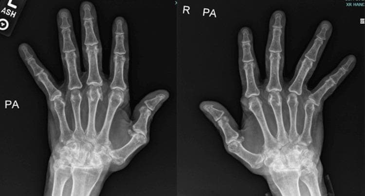 Posteroanterior (PA) view X-ray of both hands demonstrating chronic inflammatory arthritis, consistent with advanced rheumatoid arthritis. The bilateral images reveal significant involvement of the metacarpophalangeal (MCP) joints, characterized by marked joint space narrowing and subluxation where the proximal phalanges are partially displaced from the metacarpal heads. Classical ulnar deviation of the digits is present. The radiograph also shows cortical erosions and architectural distortion at the MCP and carpal joints, indicative of progressive erosive disease. The interphalangeal joints show milder changes compared to the MCP and wrist regions. These findings represent a late-stage manifestation of an inflammatory arthropathy, resulting in substantial joint deformity and malalignment. The image serves as a clinical teaching tool for recognizing radiographic hallmarks of chronic rheumatoid arthritis, including ulnar drift, subluxation, and symmetric joint space loss in the small joints of the hand.