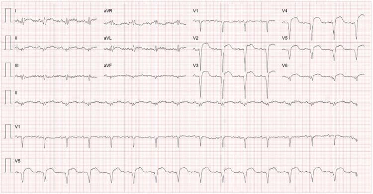 A 12-lead electrocardiogram (ECG) demonstrating signs of an acute anterior wall myocardial infarction (STEMI). The tracing shows significant ST-segment elevation across the precordial leads, specifically from V2 to V6. The ST elevation is most pronounced in leads V2, V3, and V4, exhibiting a convex upward morphology often referred to as 'tombstoning.' This is accompanied by prominent, peaked T-waves in the same leads. Leads V5 and V6 show a relative decrease in the degree of ST elevation compared to the mid-precordial leads. Reciprocal ST-segment depression is visible in the inferior leads (II, III, and aVF). The rhythm appears to be sinus with baseline artifact present in the limb leads. This diagnostic image illustrates the classic electrical progression of an anterior ST-elevation myocardial infarction, indicating occlusion of the left anterior descending (LAD) coronary artery or its branches, which is a critical finding in cardiovascular emergency medicine.