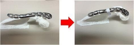 This comparison photograph illustrates the pre-operative planning and contouring of an orthopedic osteosynthesis plate using a patient-specific 3D-printed anatomical model. The images show a side-by-side 'before' and 'after' view of a metallic 3.5-mm locking compression plate (LCP) being adapted for acromial fixation. The plate features a series of Combi holes, designed for both angle-stable locking screws and dynamic compression cortical screws. In the left frame, the distal clavicle reconstruction plate is positioned relatively flat against the white 3D-printed model of the acromion. In the right frame, following manual contouring with plate benders, the plate exhibits a distinct anterior curvature. This adjustment is designed to lift the anterior acromion, correcting for down-sloping to prevent subacromial impingement on the rotator cuff. The use of 3D printing in this context demonstrates advanced surgical planning for complex orthopedic anatomy where standard pre-contoured plates are unavailable.
