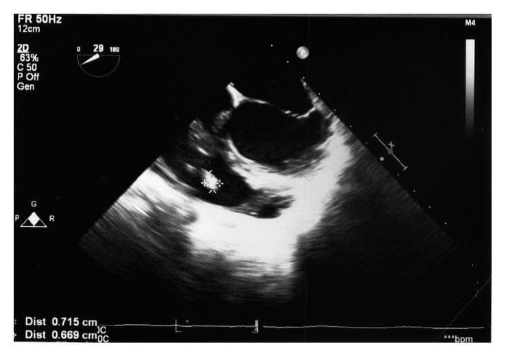 This diagnostic image is a 2D transoesophageal echocardiogram (TOE) demonstrating a significant finding in the context of infective endocarditis. The primary focus is a distinct, hyperechoic, irregular mass marked with white asterisks, identified as a cardiac vegetation. Electronic calipers measure the structure's dimensions at approximately 0.715 cm by 0.669 cm. The vegetation is attached to the posterior leaflet of the tricuspid valve, visible within the right-sided heart chambers. Technical parameters displayed include a frame rate (FR) of 50Hz, imaging depth of 12cm, and a sector angle of 29 degrees. This visual is clinically significant for the diagnosis and monitoring of tricuspid valve endocarditis, illustrating the persistence of vegetation size despite antibiotic therapy. Key educational concepts include ultrasound echogenicity of vegetations, tricuspid valve anatomy, and the application of Duke's criteria in clinical cardiology.