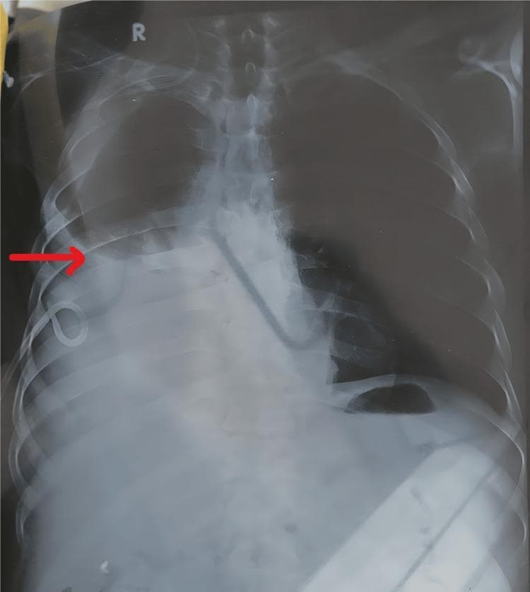 Anteroposterior (AP) chest X-ray demonstrating a moderate to large right-sided pleural effusion and a pigtail catheter in situ. The right hemithorax shows significant basal opacity with obscuration of the right costophrenic angle and hemidiaphragm. A curvilinear meniscus sign is visible at the upper margin of the fluid collection. A pigtail catheter is seen entering the right lateral chest wall, with its distal curled tip positioned superiorly within the pleural space. The left hemithorax displays a blunted costophrenic angle, suggestive of a concurrent mild left-sided pleural effusion. The cardiac silhouette is partially obscured, and the trachea remains midline. This diagnostic image illustrates pleural drainage management in a clinical setting, typically associated with conditions such as chronic liver disease or hepatohydrothorax, and highlights the radiological signs of bilateral pleural involvement and medical device placement.