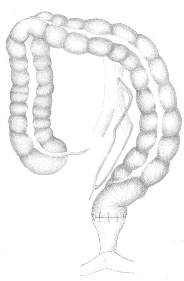 This medical anatomical illustration depicts the surgical anatomy of the colon and its arterial supply following a 'low tie' ligation of the inferior mesenteric artery (IMA). The diagram shows the colon with characteristic sacculated haustra, looping through the abdominal cavity. A significant portion of the distal colon is shown undergoing an anastomosis, indicated by visible surgical sutures at the junction with the rectum. The vascular network illustrates the preservation of the left colic artery while showing ligation of the IMA branches distal to its origin from the aorta. The arterial branches are shown traveling through the mesentery to reach the mesenteric border of the colon, providing collateral circulation to the splenic flexure and descending colon. This illustration serves as an educational resource for colorectal surgery, specifically demonstrating oncological resection techniques and the preservation of blood supply to the conduit during low anterior resections.