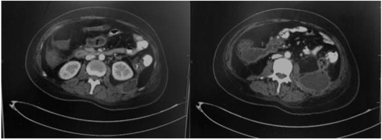 Two axial slices of a contrast-enhanced computed tomography (CT) scan of the abdomen demonstrate severe acute pancreatitis with extensive complications. The imaging shows a large, heterogeneous fluid collection in the left retroperitoneal space and left paracolic gutter, characterized by significant inflammatory fat stranding around the pancreas. Key findings include the presence of multiple air bubbles within the necrotic collections, suggestive of an emphysematous infection or secondary infected necrosis. Additionally, there is evidence of a colonic fistula involving the descending colon. The slices further reveal gallbladder stones without biliary tree dilatation. The findings are consistent with Balthazar Grade E acute pancreatitis, showcasing advanced local complications including walled-off necrosis, infection, and hollow viscus fistulization.