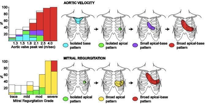 This medical comparison chart and diagram illustrate the distribution patterns of systolic murmurs in isolated Aortic Stenosis (AS) and Mitral Regurgitation (MR) based on disease severity. The upper section focuses on Aortic Velocity (n=247), showing a progression of murmur localization as peak velocity increases from 1.3 to 4.0 m/sec. Visualized patterns include isolated base (cyan), isolated apical (green), small apical-base (purple), and broad apical-base (red). As AS severity increases, the murmur evolves from localized base or apex patterns to a broad apical-base distribution. The lower section depicts Mitral Regurgitation patterns (n=174) graded from trace to severe. Murmur patterns are categorized as isolated apical (green), broad apical (yellow), and broad apical-base (red). The bar graphs quantify the percentage of patients exhibiting each pattern at different severity levels, highlighting that severe cases of both AS and MR are characterized by broader, more extensive apical-base murmur distributions on the chest wall.