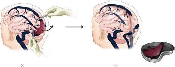 Two-part medical illustration depicting a neurosurgical resection of a tumor involving the dural venous sinuses. (a) This anatomical diagram shows a sagittal-lateral view of the brain with a large, reddish, vascularized mass (identified in context as a hemangiopericytoma) invading the confluence of sinuses (CoS), the posterior third of the superior sagittal sinus (SSS), and the proximal transverse sinus. Surgeon hands are illustrated using microsurgical instruments to perform silk knot ligatures at the tumor margins and the invaded sinuses. (b) The follow-up diagram shows the post-resection state. The tumor has been removed en-bloc and is displayed in a surgical kidney dish. The primary brain illustration depicts the empty surgical bed at the occipital region, showing the ligated ends of the SSS and transverse sinuses. The diagram highlights the surgical management of complex dural sinus tumors and the radical resection technique required for aggressive vascular lesions.