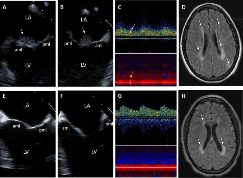 This composite figure illustrates the clinical progression and treatment response of Libman-Sacks endocarditis in an 18-year-old female. Panels A and B are 2-D transesophageal echocardiography (TEE) orthogonal views showing a large, sessile, oval-shaped vegetation (arrows) on the atrial side of the anterior mitral leaflet (aml). Panel C displays a Transcranial Doppler (TCD) of the right middle cerebral artery, identifying microemboli (arrows). Panel D is a brain Magnetic Resonance Imaging (MRI) axial Diffusion-Weighted Image (DWI) demonstrating multiple bilateral periventricular hyperintense lesions indicative of acute cerebral infarcts. Panels E through H show follow-up imaging after 9 weeks of immunosuppressive and anticoagulant therapy. Panels E and F (TEE) reveal complete resolution of the mitral valve vegetations and restoration of smooth leaflet morphology. Panel G (TCD) shows the absence of cerebromicroembolism. Panel H (MRI DWI) demonstrates a significant reduction in the lesion load and intensity of the periventricular white matter infarcts. The set serves as a comprehensive example of the multi-organ involvement of systemic lupus erythematosus-related endocarditis and the efficacy of targeted medical management in reducing embolic sources and secondary neurological complications.