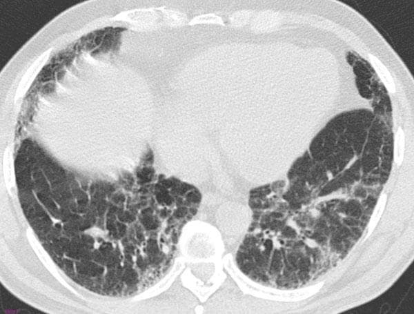 High-resolution computed tomography (HRCT) axial scan of the chest at the level of the lower lobes demonstrating parenchymal abnormalities. The image shows bilateral, predominantly peripheral, and basal patchy ground-glass opacities (GGO), appearing as areas of hazy increased lung attenuation that do not obscure the underlying pulmonary vasculature. Intermixed with the GGO is a fine reticular pattern, characterized by linear opacities representing interstitial thickening. While the biopsy confirmed Usual Interstitial Pneumonia (UIP), the HRCT lacks definitive features of a UIP pattern, such as honeycombing or significant traction bronchiectasis; instead, the diffuse, symmetric distribution and predominant GGO are more suggestive of a Nonspecific Interstitial Pneumonia (NSIP) pattern. This case serves as a clinical example of the discordance between radiologic patterns and histologic findings in interstitial lung disease (ILD), highlighting the importance of multidisciplinary diagnosis.