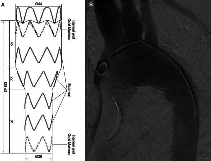 Educational medical graphic illustrating Thoracic Endovascular Aortic Repair (TEVAR) for Patent Ductus Arteriosus (PDA). (A) Schematic diagram of a custom-made tapered stent graft, showing the structural architecture with zig-zag external struts and radio-opaque internal gold markers at the proximal and distal ends. Dimensions are specified: proximal diameter of 44mm, distal diameter of 26mm, and a total length of 128mm with segmented lengths of 45mm, 22mm, and 61mm. (B) Intraoperative aortography following TEVAR deployment. The digital subtraction angiography (DSA) image confirms the successful exclusion of the PDA from the aortic circulation. The stent graft is visible within the thoracic aorta, demonstrating a mesh-like metallic density. No endoleaks are observed, and the aortic arch anatomy, including proximal branch vessels, is partially visible. This visual illustrates endovascular treatment strategies for complex adult congenital heart disease or aortic pathologies, focusing on custom device design and post-procedural diagnostic imaging confirmation.