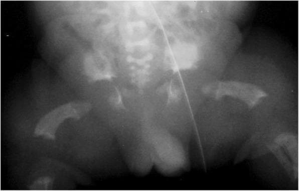 Anteroposterior (AP) radiograph of the pelvis and proximal femora of a neonate demonstrating characteristic findings of thanatophoric dysplasia, type I. The image reveals significant skeletal abnormalities. The femora are markedly shortened and robust, displaying a distinctive bowed appearance often referred to as 'telephone receiver' femora. The pelvis exhibits a squared-off morphology with small, horizontal acetabular roofs. There is prominent narrowing of the sacrosciatic notch, reflecting severe endochondral ossification defects. While these features share qualitative similarities with achondroplasia, they are quantitatively more severe in this presentation. The lumbar spine shows some evidence of platyspondyly (flat vertebral bodies). This diagnostic image is essential for medical education regarding lethal skeletal dysplasias and the radiographic differentiation between FGFR3-related conditions.
