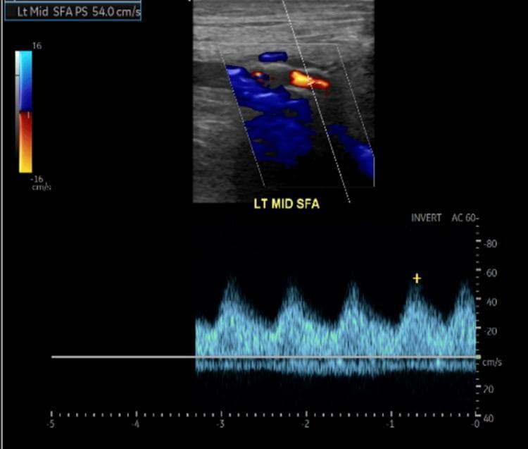 This diagnostic image is a duplex ultrasound of the left mid-superficial femoral artery (SFA), combining B-mode imaging, color Doppler, and spectral Doppler waveform analysis. The top panel shows a color Doppler box over the longitudinal view of the vessel, displaying turbulent flow with a mixture of red and blue hues, indicating variations in velocity and direction. The lower panel displays a spectral Doppler waveform indicating monophasic flow, characterized by a dampened systolic peak and a total lack of the normal early diastolic reversal and late diastolic forward flow seen in healthy peripheral arteries. The vertical axis measures velocity in cm/s, with the peak systolic velocity (PSV) measured at approximately 54.0 cm/s as indicated in the top-left annotation. Such monophasic, low-velocity waveforms are characteristic findings in peripheral artery disease (PAD), specifically suggesting hemodynamically significant proximal stenosis or occlusion. The clinical context relates to vascular assessment in a patient with lower extremity ulcers and suspected limb ischemia.