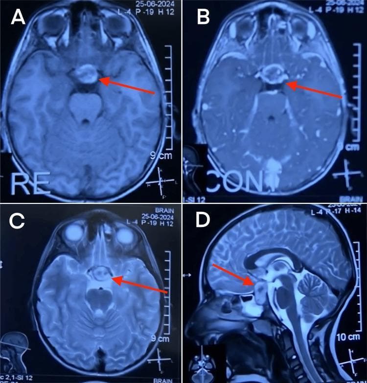 Diagnostic Magnetic Resonance Imaging (MRI) of the brain in axial and sagittal planes illustrating a sellar and suprasellar mass consistent with pituitary apoplexy. Panel A (Axial T1-weighted without contrast) reveals a mixed-intensity lesion (red arrow) indicating acute to subacute hemorrhage within the pituitary gland. Panel B (Axial T1-weighted with contrast) demonstrates peripheral enhancement around the non-enhancing core, suggesting peripheral vascularization or infarction. Panel C (Axial T2-weighted) shows a hyperintense signal within the lesion, indicative of edema or blood products. Panel D (Sagittal T2-weighted) provides anatomical orientation, showing the lesion's expansion within the sella turcica and its significant suprasellar extension, causing compression of the optic chiasm. Key landmarks include the sphenoid sinus, sella turcica, brainstem, and optic chiasm. This radiological series demonstrates the diagnostic features of pituitary macroadenoma complicated by hemorrhage (apoplexy), highlighting its relationship to surrounding neuro-anatomical structures for surgical planning.