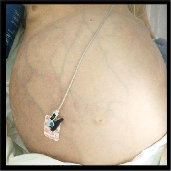 This clinical photograph shows a supine patient with severe abdominal distension, exhibiting a prominently rounded and protuberant abdominal contour. The skin surface demonstrates a diffuse network of dilated, tortuous, and branching collateral venous circulation (caput medusae-like appearance) visible across the entire abdominal wall. The superficial veins appear bluish through the stretched, translucent skin. A medical monitoring electrode is attached to the lower left quadrant. This visual presentation is characteristic of increased intra-abdominal pressure or portal hypertension, leading to the recruitment of superficial portosystemic collaterals. In this clinical context, the distension is secondary to massive fecal impaction causing abdominal compartment syndrome. The image illustrates a critical sign of obstructive pathology and vascular compromise relevant to emergency medicine and gastroenterology.