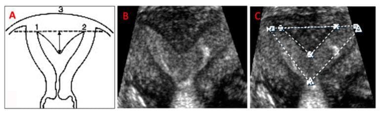 This composite image illustrates the 3-D ultrasound evaluation and measurement of a uterine subseptation, a common Müllerian duct anomaly. Panel A presents a schematic diagram of a subseptate uterus, labeling the left (1) and right (2) tubal ostia and the fundal outer contour (3). A vertical arrow demonstrates the measurement of subseptation length from the inter-ostial line to the apex of the septum. Panel B displays a 3-D ultrasound coronal view rendering, showing the characteristic Y-shaped indentation of the endometrial cavity with a convex fundal external contour. Panel C demonstrates the clinical measurement technique on the ultrasound rendering; dotted lines delineate the cavity width (between the tubal ostia), the subseptation width at its base, and the subseptation length. These standardized measurements are critical for distinguishing between arcuate and septate uteri and for calculating the cavity area, which informs surgical planning for hysteroscopic incision.