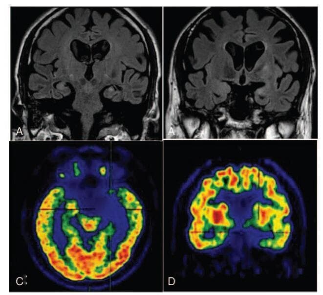 This composite diagnostic image displays neuroimaging findings in a patient with anti-LGI1 limbic encephalitis. Panels A and B are coronal T2-weighted Fluid-Attenuated Inversion Recovery (T2W FLAIR) MRI scans. Panel A demonstrates abnormal hyperintensities within the left medial temporal lobe and hippocampus, while Panel B reveals moderate hippocampal atrophy, classified as Medial Temporal Lobe Atrophy (MTA) score 3. Panels C and D provide functional assessment via 18F-FDG PET/CT. Panel C (axial view) shows hypometabolism, indicated by a partial absence of radioactivity (cool blue tones) in the left medial temporal cortex and hippocampus compared to the contralateral side. Panel D (coronal view) highlights markedly reduced tracer uptake in the head of the left caudate nucleus. Collectively, these images illustrate the correlation between structural MRI changes (hyperintensity and atrophy) and functional PET deficits (hypometabolism) characteristic of autoimmune limbic encephalitis involving the medial temporal lobes and basal ganglia.