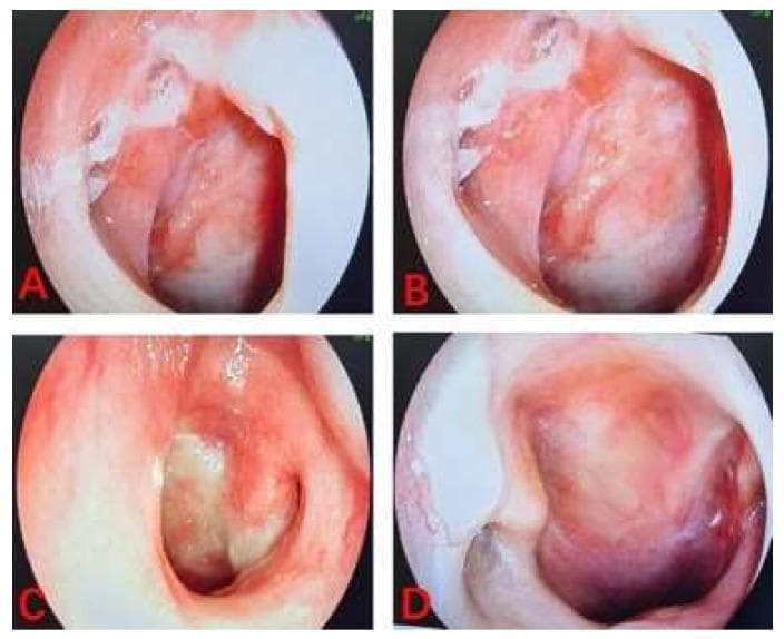 A series of four endoscopically captured clinical photographs (A-D) demonstrating the nasopharyngeal cavity in a patient with nasopharyngeal carcinoma (NPC) during a nasopharyngeal lavage procedure. Images A and B show the posterior nasopharyngeal wall and lateral recesses with visible mucosal erythema and irregular, pale leucoplakic patches alongside hyperemic, inflamed tissue. The surface texture appears granular and uneven. Image C highlights a deep diagnostic view of the fossa of Rosenmüller, showing significant mucosal thickening and inflammatory exudate. Image D reveals a prominent, exophytic, or submucosal mass lesion with a deeper violaceous hue, characteristic of tumor progression or bulk in the nasopharynx. The series illustrates the anatomical landmarks and pathological mucosal changes relevant to otolaryngology and oncological assessment of NPC. Key educational concepts include endoscopic recognition of nasopharyngeal malignancies, tissue inflammation, and the visualization of tumor masses within the pharyngeal space.