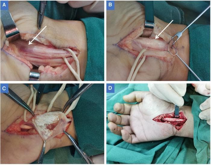 A series of four intraoperative clinical photographs (A-D) documenting a surgical decompression for carpal tunnel syndrome caused by tophaceous gout. (A) Shows the exposed median nerve in the palm after transverse carpal ligament release, highlighting a localized area of dark red discoloration and physical indentation (white arrow) indicating chronic compression. (B) Displays the median nerve retracted ulnarly to reveal a fusiform, swollen flexor tendon sheath of the index finger (white arrow) that was causing the nerve compression. (C) Depicts the opened flexor tendon sheath, revealing a large accumulation of milky-white, soft, chalky tophi (monosodium urate crystals) characteristic of chronic gouty tenosynovitis. The surrounding sheath appears intact without acute ulceration. (D) Shows the operative field following tophi removal and tenosynovectomy, illustrating the resolution of the compressive mass. This sequence demonstrates an uncommon cause of carpal tunnel syndrome where intratendinous gouty deposits mechanically compress the median nerve within the carpal canal.