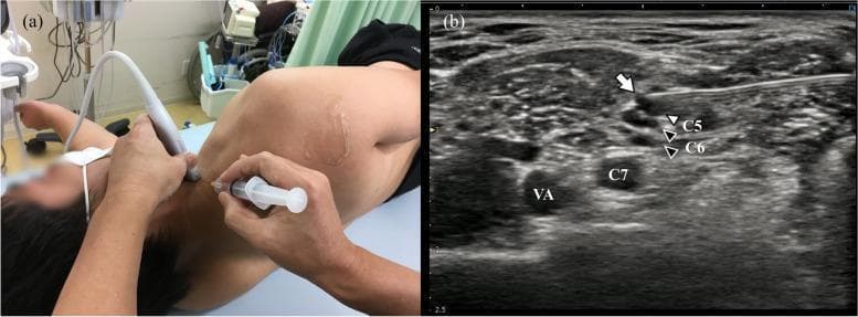 This composite image illustrates the clinical application of ultrasound-guided regional anesthesia. Image (a) is a clinical photograph showing a patient in the lateral recumbent position. A practitioner is performing an ultrasound-guided cervical nerve block, with a linear probe placed on the lateral neck and a syringe/needle assembly inserted via an in-plane approach. Image (b) is the corresponding transverse sonogram of the interscalene brachial plexus region. It highlights anatomical landmarks including the C5 and C6 nerve roots (marked with white and black arrowheads), the C7 nerve root located more deeply and medially, and the pulsatile vertebral artery (VA). A hyperechoic needle (white arrow) is visualized with the tip positioned precisely near the C5 and C6 nerve roots, which are merging to form the superior trunk. This educational material demonstrates the correct needle-to-nerve relationship and anatomical localization required for safe and effective interscalene or cervical nerve blocks in pain management and orthopedic surgery.