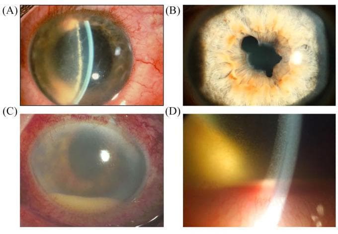 This set of four slit-lamp clinical photographs (A–D) illustrates the hallmark findings of acute anterior uveitis (AAU) and severe breakdown of the blood-iris barrier. Image (A) demonstrates significant ciliary injection (perilimbal redness) and fibrin exudation near the pupil margin. Image (B) shows an irregular pupil shape characteristic of posterior synechiae, where the iris becomes pathologically adherent to the anterior lens capsule. Images (C) and (D) depict severe intraocular inflammation featuring a prominent hypopyon—a layer of white blood cells (leukocytes) settled at the bottom of the anterior chamber due to gravity. Additional findings include diffuse conjunctival hyperaemia, fibrin coating on the anterior lens surface, and evidence of aqueous flare. These images are essential for teaching the clinical manifestations of spondyloarthritis-associated ocular disease and the quantification of anterior segment inflammation.