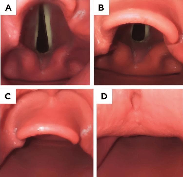 This set of four endoscopic images (A-D) illustrates the Cormack-Lehane (CL) grading system, a standardized clinical tool used in anesthesiology to assess the difficulty of tracheal intubation based on laryngeal visibility during direct laryngoscopy. Image A (Grade I) shows full visualization of the glottic opening, including the anterior and posterior commissures and clear vocal cords. Image B (Grade II) demonstrates partial glottic visualization; the posterior portion is visible, but the anterior commissure is obscured by the epiglottis. Image C (Grade III) shows only the epiglottis, with no glottic structures or vocal cords visible, representing a difficult airway scenario. Image D (Grade IV) shows no identifiable laryngeal structures, indicating only soft palate or oropharyngeal tissue is visible, often requiring advanced airway management techniques. This comparison serves as an educational reference for medical students and clinicians for airway assessment and predicting potential intubation difficulty.