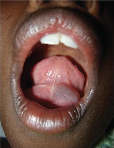 Clinical photograph of an open oral cavity in a pediatric patient, demonstrating a large, cystic swelling in the floor of the mouth. The lesion is located sublingually and is primarily situated on the left side, though it appears to cross the midline. The swelling exhibits a translucent, bluish, or 'frog-belly' hue, characteristic of a ranula (mucous extravasation cyst). Superficial vascularity is visible on the stretched mucosal surface covering the cyst. The tongue is displaced superiorly and posteriorly by the mass. The image highlights the typical intraoral presentation of a sublingual gland mucocele, which can extend into deeper cervical spaces as a 'plunging ranula.' Clinical relevance includes differential diagnosis of oral floor masses such as dermoid cysts or hemangiomas, and educational focus is on the visual identification of salivary gland pathologies in pediatric dentistry and oral surgery.