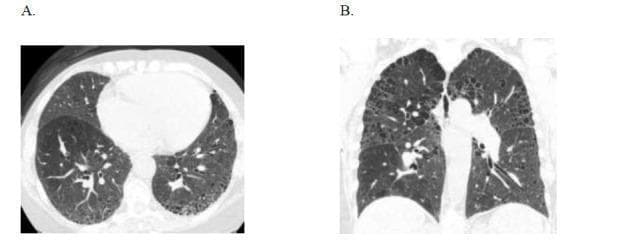 These axial (A) and coronal (B) High-Resolution Computed Tomography (HRCT) images of the chest demonstrate a classic radiographic pattern of Usual Interstitial Pneumonia (UIP). The predominant finding is subpleural honeycombing, characterized by clusters of cystic airspaces with well-defined walls, primarily localized along the costal and fissural pleural surfaces. This honeycombing is most extensive in the lower lung zones and bases. Additional findings include mild biapical paraseptal emphysema, visualized as small subpleural lucencies at the lung apices. The lung architecture is distorted by these fibrotic changes, leading to the replacement of normal parenchyma with cystic spaces. This pattern is characteristic of interstitial lung disease associated with connective tissue disorders, such as rheumatoid arthritis. The imaging is critical for differentiating UIP from other patterns like Non-Specific Interstitial Pneumonitis (NSIP) based on the presence of macrocystic honeycombing and its peripheral, basal-predominant distribution.