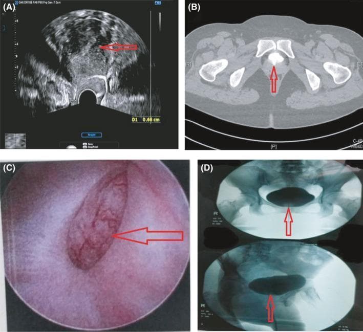 A four-panel figure illustrating diagnostic findings of a vesicouterine fistula (VUF). (A) Transvaginal ultrasound (TVUS) showing an interruption in the continuity of the anterior cervical wall at the internal os level (red arrow), indicating communication between the cervical canal and the bladder. (B) Axial pelvic CT (enhanced urography) demonstrating speckled high-density contrast media within the uterus, situated posterior/inferior to the bladder, confirming fistulous passage. (C) Cystoscopic view revealing a well-defined mucosal defect (approximately 3x2 cm) located superior to the trigone of the bladder. (D) Radiographic fluoroscopy during a methylene blue and contrast medium instillation test, depicting the bladder filled with contrast and demonstrating slight leakage into the vaginal vault. This series serves as a multimodal diagnostic comparison for detecting abnormal pelvic communications, typically presenting with Youssef's syndrome (cyclic hematuria and menouria).