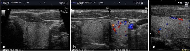 Diagnostic ultrasound imaging of the thyroid gland demonstrating characteristic TIRADS 3 thyroid incidentalomas. Panel (a) and (b) show a predominantly hyperechoic solid nodule located in the left thyroid lobe. The lesion features sharp, well-defined margins and is encircled by a peripheral hypoechoic halo. Color Doppler imaging in panel (b) reveals significant peripheral vascularization, appearing as a 'basket-weave' pattern of blood flow around the nodule's edge. Panel (c) illustrates a second nodule characterized as isoechogenic relative to the surrounding parenchyma, also exhibiting a peripheral hypoechoic halo and peripheral Doppler signals. These sonographic findings represent low-risk nodules (TIRADS 3) typically characterized by benign growth patterns, intended for medical education regarding thyroid cancer risk stratification and ultrasonographic morphological assessment.
