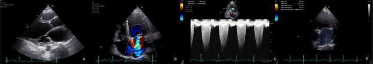 This composite diagnostic image features four panels of a transthoracic echocardiogram (TTE) demonstrating severe mitral regurgitation and associated cardiac remodeling. Panel A shows a parasternal long-axis view revealing left-sided chamber enlargement. Panel B displays a color Doppler apical 4-chamber view, highlighting a large, eccentric regurgitant jet (predominantly red and yellow) that fills a significant portion of the dilated left atrium, consistent with grade 4 mitral regurgitation. Panel C presents continuous-wave spectral Doppler across the mitral valve, showing a dense, holosystolic, high-velocity signal, indicating a high-volume regurgitant flow. Panel D provides an apical view with volumetric measurements, confirming severe left atrial dilation. The images collectively illustrate functional mitral regurgitation in the setting of heart failure, characterized by valvular insufficiency and subsequent bi-atrial enlargement. The study is clinically significant for diagnosing Ortner's syndrome (cardiovocal syndrome) caused by the compression of the recurrent laryngeal nerve by the markedly enlarged left atrium.