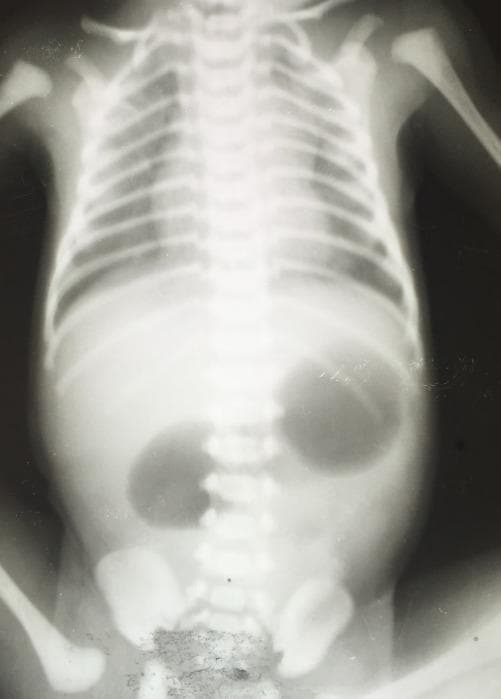 This abdominal X-ray of a neonate demonstrates the classic 'double bubble' sign, a hallmark radiographic finding for duodenal obstruction. The image reveals two prominent, rounded, radiolucent (air-filled) areas in the upper abdomen: one representing the distended stomach and the other representing the dilated proximal duodenum. These two gas bubbles are separated by the pylorus. Notably, there is a complete absence of distal bowel gas (a 'gasless' distal abdomen), which strongly suggests complete atresia rather than a partial stenosis. The skeletal structures shown, including the ribs and spine, are consistent with a newborn. In clinical practice, this presentation is most commonly associated with congenital duodenal atresia, frequently seen in infants with Trisomy 21 (Down syndrome), or other obstructive pathologies such as annular pancreas or malrotation with Ladd bands. This diagnostic image is essential for pediatric surgical evaluation and confirms a high gastrointestinal obstruction requiring immediate clinical management.