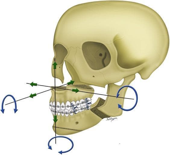 This medical anatomical diagram illustrates the principles of two-jaw orthognathic surgery using a single-splint technique for skeletofacial reconstruction. The illustration depicts a human skull with a Le Fort I osteotomy of the maxilla and a bilateral sagittal split osteotomy (BSSO) of the mandibular ramus. These procedures separate the maxilla and the distal segment of the mandible, which are then integrated into a single 'maxillo-mandibular complex' (MMC) using a surgical occlusion splint and orthodontic hardware. The diagram uses colored arrows to represent the six degrees of freedom in 3D surgical planning and movement. Green linear arrows indicate en-bloc translational movements along the X, Y, and Z axes, including horizontal shifts (left/right), antero-posterior movements (advancement/setback), and vertical movements (intrusion/extrusion). Blue curved arrows represent rotational movements, specifically pitch, roll, and yaw. This visual aid is designed for surgical education in maxillofacial and plastic surgery, demonstrating how virtual 3D simulations are transferred to physical skeletal repositioning during corrective jaw surgery.