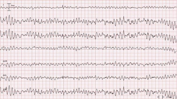 This diagnostic image is an electrocardiogram (ECG) rhythm strip displaying Torsades de Pointes (TdP), a specific form of polymorphic ventricular tachycardia. The tracing shows a continuous, irregular rapid rhythm characterized by the hallmark visual feature of QRS complexes 'twisting' around the isoelectric baseline. This manifest as cyclical variations in QRS amplitude and morphology, where the complexes wax and wane in size and periodically flip their polarity. The ECG lacks discernible P waves, normal QRS complexes, or T waves, indicating an absence of organized atrial or ventricular repolarization. Multiple leads (I, II, III, V, AVR, AVL, and AVF) are shown on a standard grid, with the polymorphic nature and shifting axis most prominent in the limb leads. Clinically, this pattern is often associated with a prolonged QT interval and represents a life-threatening arrhythmia requiring immediate intervention, such as magnesium sulfate or defibrillation.