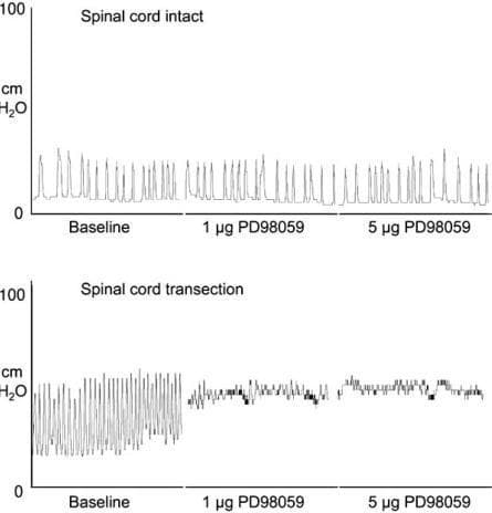 This diagnostic image consists of two cystometrogram (bladder pressure) tracings comparing 'Spinal cord intact' and 'Spinal cord transection' conditions in an experimental model. The vertical axis measures bladder pressure in cm H2O, and the horizontal axis represents time under three conditions: Baseline, 1 μg PD98059, and 5 μg PD98059. In the 'Spinal cord intact' panel, regular, low-amplitude bladder contractions are visible at baseline, and these remain unchanged following the intrathecal administration of increasing doses of PD98059 (a MEK inhibitor). In the 'Spinal cord transection' panel, the baseline shows high-frequency, high-amplitude bladder reflex activity, characteristic of neurogenic detrusor overactivity. Following the administration of PD98059, there is a dose-dependent decrease in both the frequency and amplitude of these contractions, with the 5 μg dose resulting in a significant stabilization of bladder pressure. The content illustrates the role of MAP kinase signaling in neurogenic bladder dysfunction and the potential therapeutic effect of pathway inhibition on reflex micturition in spinal cord injury scenarios.