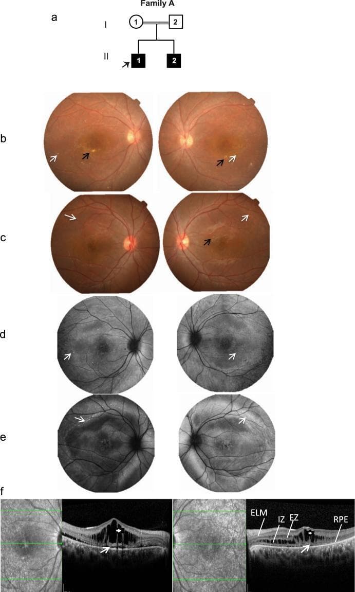 This composite educational image illustrates the clinical and multimodal imaging features of Autosomal Recessive Bestrophinopathy (ARB) in Family A. (a) A pedigree diagram shows two affected siblings with recessive inheritance. (b, c) Color fundus photographs of the proband and sibling display focal macular subretinal fibrosis (black arrows) and sparse, yellowish vitelliform deposits (white arrows). (d, e) Fundus autofluorescence (FAF) images demonstrate corresponding focal dots of hyper-autofluorescence in the macula. (f) Optical Coherence Tomography (OCT) cross-sections reveal significant intraretinal cystoid and schitic changes (white asterisks) primarily in the inner and outer nuclear layers, accompanied by minimal subretinal fluid (white arrows). The OCT images also label key retinal layers: External Limiting Membrane (ELM), Ellipsoid Zone (EZ), Interdigitation Zone (IZ), and Retinal Pigment Epithelium (RPE). The visual data emphasizes the macular structural disruption and retinal architectural changes characteristic of BEST1 gene mutations.