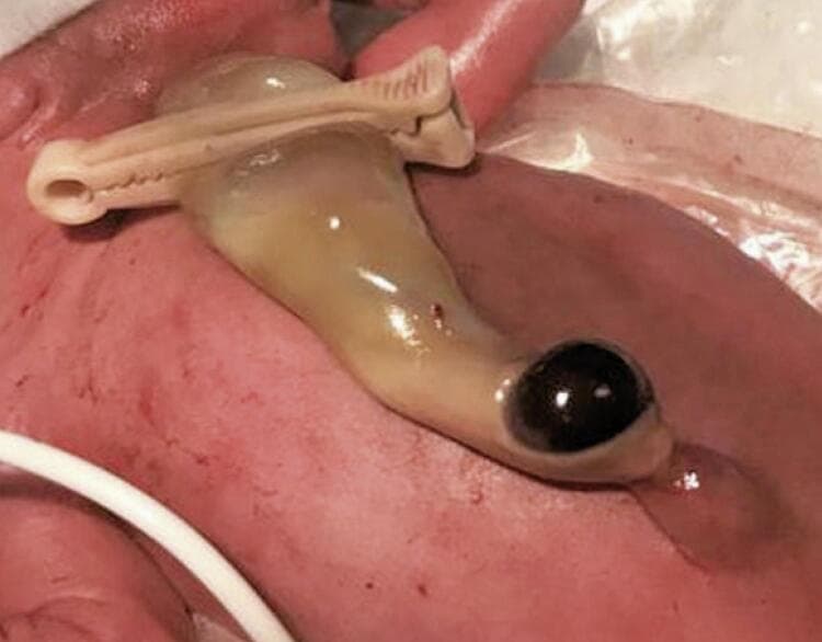This clinical photograph shows a close-up view of a newborn's abdominal wall and umbilical cord, demonstrating a localized umbilical cord hematoma (UCH). The cord is secured distally with a white plastic umbilical clamp. The proximal portion of the cord near the insertion site at the umbilicus features a distinct, rounded, tense, brownish-purple swelling, characteristic of an acute hematoma. The surrounding cord tissue appears pale yellow and slightly edematous. A small amount of clear serous fluid is visible near the base of the lesion. The newborn's skin is erythematous with visible superficial vasculature, consistent with a preterm infant. A white medical tube or line is visible in the lower left periphery, indicating a neonatal intensive care setting. This image serves as an educational example of neonatal umbilical cord pathology, specifically differentiating a benign hematoma from other umbilical masses such as omphalocele or umbilical hernia.