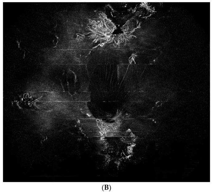 This Wide-Field Optical Coherence Tomography Angiography (WF-OCTA) image demonstrates proliferative diabetic retinopathy (PDR). The image is an internal limiting membrane (ILM) slab en face view, which highlights vascular structures at the vitreoretinal interface. Prominent, bright, disorganized tufts of neovascularization (NV) are visible, particularly in the superior and inferior regions. These hyperreflective features represent pathological new vessels protruding from the retina into the vitreous cavity. The surrounding background shows significant areas of hypoperfusion and signal void, consistent with retinal ischemia. Horizontal linear artifacts are present across the scan, likely related to eye movement or image acquisition. The central area displays a darker, dense signal void which may correspond to shadowing from an overlying vitreous hemorrhage. This diagnostic image is used to assess the extent of neovascularization elsewhere (NVE) and guide treatment decisions in advanced diabetic eye disease.