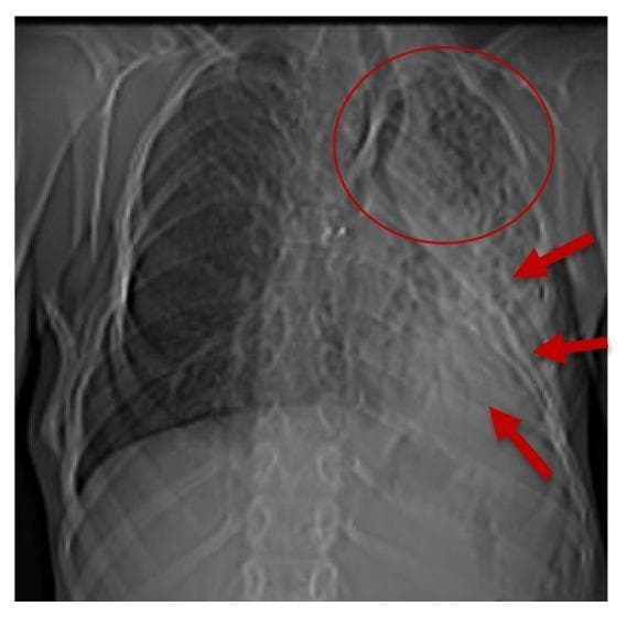 Frontal chest x-ray demonstrating multi-lobar pathology in the left lung with associated mediastinal changes. Key findings include a dense opacity in the left lower lobe consistent with atelectasis (indicated by red arrows) and reticular, net-like infiltrates throughout the left upper lobe (circled in red), suggesting an alveolo-interstitial pneumopathy. There is a noticeable ipsilateral shift of the mediastinum towards the left, signifying volume loss. The right lung appears hyperinflated, providing a compensatory response to the left-sided collapse. Additionally, the image shows evidence of extraskeletal calcification near the tracheal bifurcation and possible heterotopic bone formation in the right laterodorsal region. These findings are highly relevant for diagnosing complex systemic conditions manifesting with respiratory impairment and progressive ossification, such as fibrodysplasia ossificans progressiva (FOP).