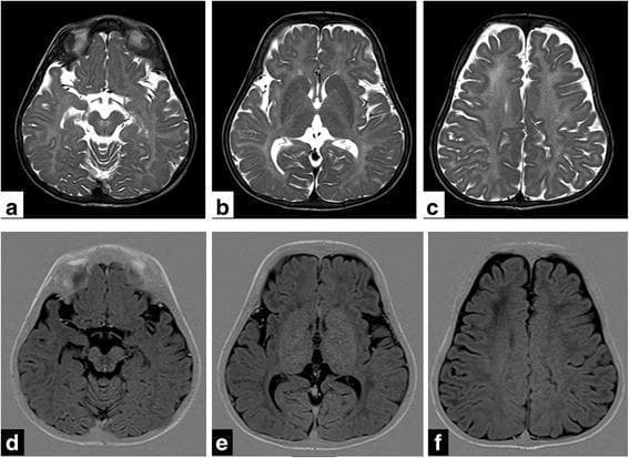 Diagnostic axial MRI sections of the brain in a 1.5-year-old child demonstrating classic features of hypomyelination and cerebral atrophy. Panels (a-c) show T2-weighted turbo spin-echo (TSE) images, while panels (d-f) show corresponding T1-weighted inversion recovery (IR) images. There is diffuse, symmetric signal alteration throughout the cerebral white matter, manifesting as hyperintensity on T2WI and hypointensity on T1WI. These changes specifically involve the internal and external capsules, the corpus callosum, frontal deep white matter, and the pre-aqueductal region. In addition to the white matter signal changes, there is notable diffuse prominence of the cerebral sulci and enlargement of the subarachnoid spaces, indicative of generalized cerebral atrophy. Clinically, this pattern of hypomyelination combined with hypodontia and hypogonadotropic hypogonadism (suggested by the '4H syndrome' context) is characteristic of RNA polymerase III-related leukodystrophy (POLR3A mutation). The images serve as an educational example of leukodystrophy classification based on signal intensity on standard MRI sequences.