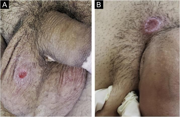 Clinical photograph consisting of two panels (A and B) showing primary syphilis manifestations (hard chancres) in the male genital region. Panel A displays a single, well-defined, round ulcer on the scrotal skin. The lesion features a characteristic 'clear' reddish base and smooth sloping edges. The surrounding scrotal and penile skin also exhibits depigmented patches consistent with comorbid vitiligo. Panel B shows a larger, cupuliform lesion located on the pubis near the base of the penis. This lesion demonstrates significant induration (infiltration) at the base, resulting in a raised, crater-like morphology. These visuals serve as educational examples of Treponema pallidum infection sites, highlighting the classic morphology of the hard chancre: a generally painless, indurated ulcer with a clean base. The clinical context notes that such primary syphilitic lesions are often accompanied by regional lymphadenopathy, representing the initial stage of systemic infection.