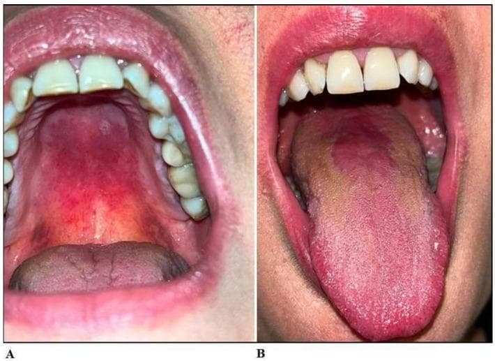Two-panel clinical photograph displaying intraoral manifestations of erythematous oral candidiasis. Panel A shows the maxillary arch and palate, characterized by diffuse erythema and focal erosive areas across both the hard and soft palate mucosal surfaces. Panel B illustrates the lingual surface, demonstrating erythematous-atrophic glossitis. The dorsal tongue exhibits a central zone of depapillation and atrophy, resulting in a smooth, red appearance, contrasted with surrounding areas that show a brownish-tan discoloration and altered texture. These clinical features are characteristic of atrophic candidiasis in a patient with chronic symptoms. This image is an educational resource for dental and medical students to identify fungal infections of the oral cavity and distinguish between palatal erythema and atrophic glossitis.