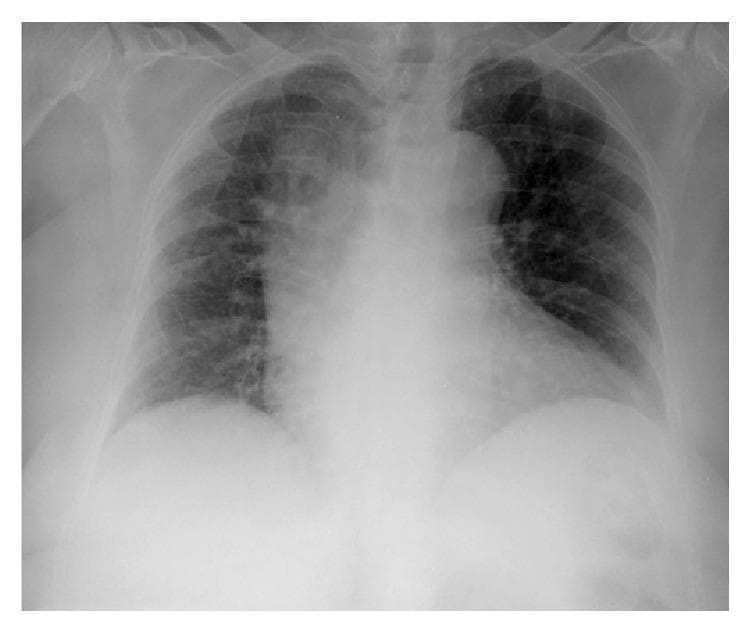 This diagnostic image is a posterior-anterior (PA) view chest X-ray demonstrating characteristic findings of pulmonary infection. The primary pathology is a focal area of increased opacity located in the right upper lobe, consistent with an alveolar infiltrate or lobar consolidation. The opacity is dense and somewhat irregular in shape, partially obscuring the superior right mediastinal border. Additionally, there is a milder, less defined area of increased opacity in the left lower lung field, suggestive of a basal infiltrate. The heart shadow is visible, though its right border is obscured by the adjacent consolidation (positive silhouette sign). Bony structures, including the ribs, clavicles, and vertebral column, are intact. The diaphragmatic domes are visualized, although the right hemidiaphragm is less sharply defined due to overlying pulmonary density. This image is an educational example of bacterial pneumonia presentation, specifically illustrating lobar consolidation patterns in the context of Moraxella catarrhalis infection.