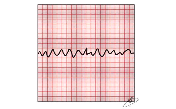 This diagnostic image shows a single-lead electrocardiogram (ECG/EKG) strip plotted on standard red grid paper, demonstrating Ventricular Fibrillation (VF). The waveform is characterized by a chaotic, irregular, and disorganized rhythm. Key morphological features include the complete absence of identifiable P waves, QRS complexes, and T waves. The tracing displays fibrillatory waves with varying amplitudes and erratic vertical deflections, indicating a lack of coordinated ventricular contraction. The amplitude of these oscillations fluctuates, generally ranging across two small grid squares relative to the isoelectric baseline. This tracing is a classic representation of a shockable cardiac arrest rhythm, emphasizing the medical importance of rapid defibrillation in Advanced Cardiovascular Life Support (ACLS) protocols. It serves as a pedagogical tool for medical students and healthcare professionals to differentiate between organized rhythms and life-threatening ventricular arrhythmias.