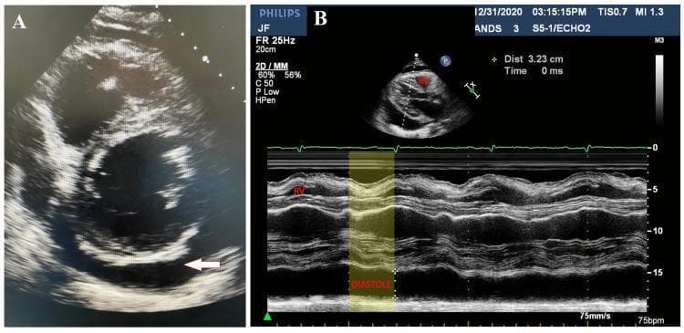 Two-panel echocardiographic study demonstrating pericardial effusion and signs of cardiac tamponade. Panel A shows a 2D transthoracic echocardiogram in a parasternal short-axis view at the basal level of the left ventricle. A large, anechoic (dark) space representing a circumferential pericardial effusion is visible surrounding the cardiac structures; a white arrow specifically highlights the posterior fluid collection. Panel B displays an M-mode echocardiogram with a simultaneous EKG trace. A yellow-shaded region highlights early diastolic collapse of the right ventricular (RV) free wall, a critical diagnostic indicator of increased intrapericardial pressure leading to hemodynamic compromise. The imagery illustrates key pathophysiological findings of cardiac tamponade, specifically the inward motion of the right ventricular wall during diastole when ventricular pressure is lowest, caused by the external pressure of the large effusion.